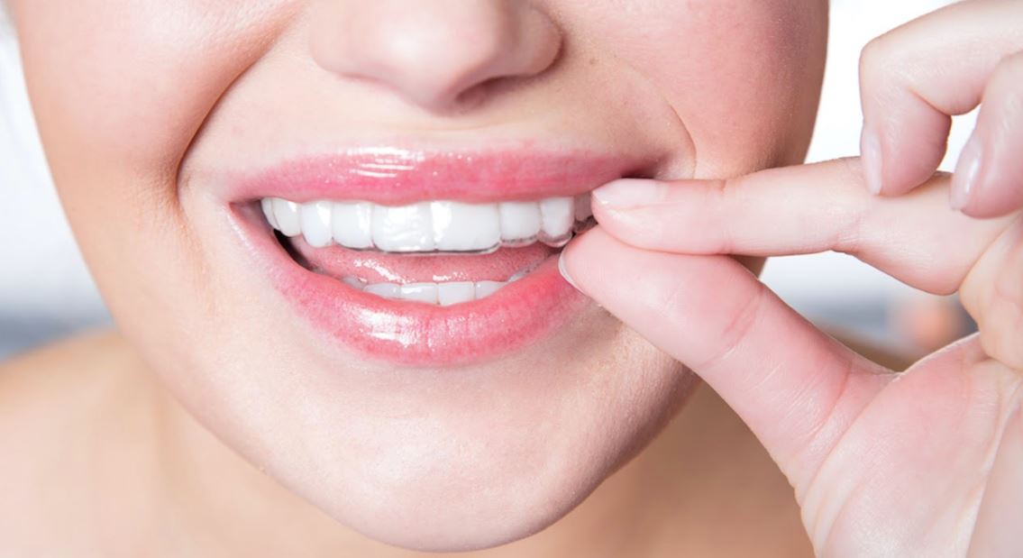 The Relevance of Invisalign Treatment